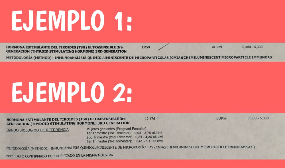 Ejemplos paraclínicos hipotiroidismo